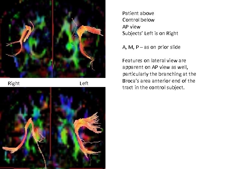 A M Patient above Control below AP view Subjects’ Left is on Right A,