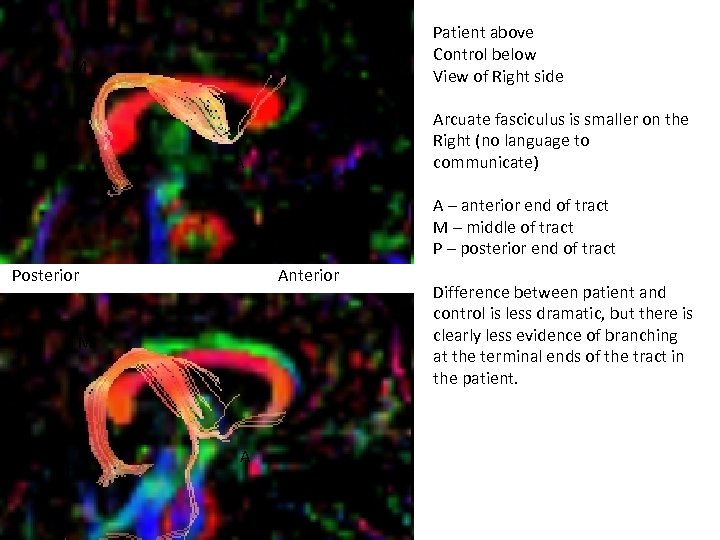 Patient above Control below View of Right side M Arcuate fasciculus is smaller on