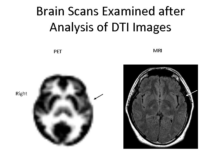 Brain Scans Examined after Analysis of DTI Images MRI PET Right 3/15/2018 37 War