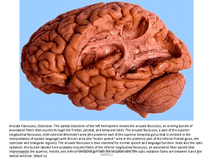 Arcuate Fasciculus, Dissection. This partial dissection of the left hemisphere reveals the arcuate fasciculus,