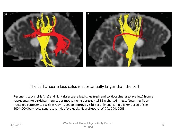 The Left arcuate fasciculus is substantially larger than the Left Reconstructions of left (a)