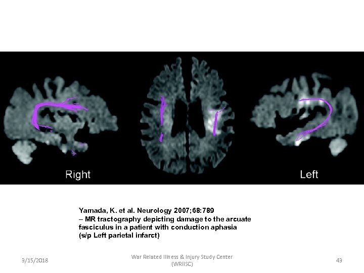 Yamada, K. et al. Neurology 2007; 68: 789 – MR tractography depicting damage to