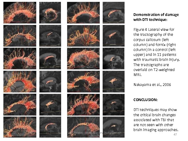 Demonstration of damage with DTI technique: Figure 4 Lateral view for the tractography of