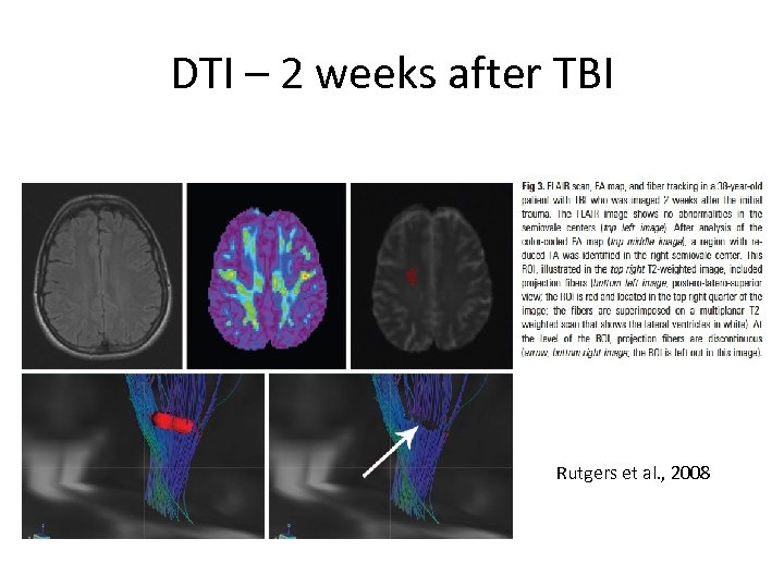 DTI – 2 weeks after TBI Rutgers et al. , 2008 