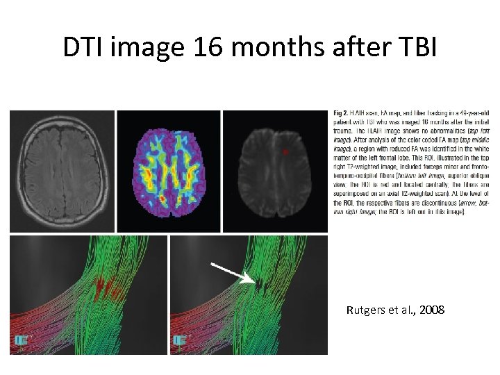 DTI image 16 months after TBI Rutgers et al. , 2008 