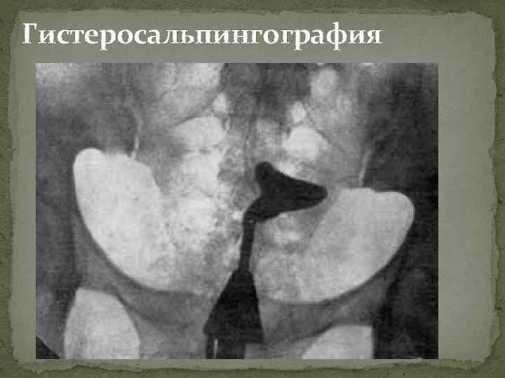 Гистеросальпингография 