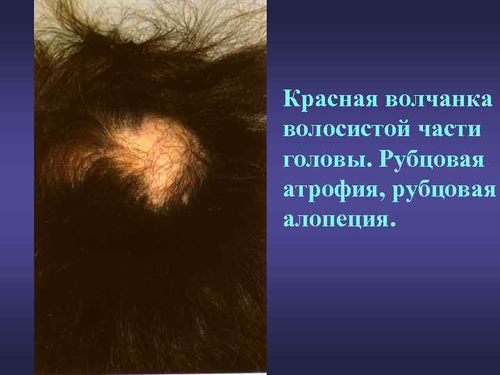 Красная волчанка волосистой части головы. Рубцовая атрофия, рубцовая алопеция. 