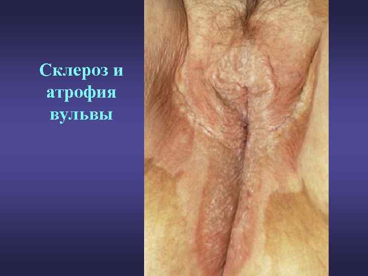 Склероз и атрофия вульвы 