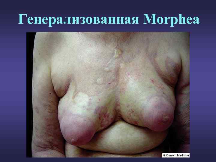 Генерализованная Morphea 