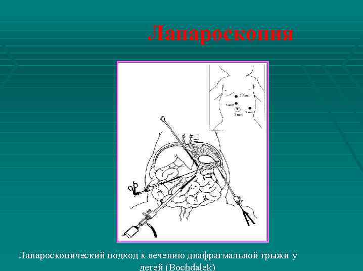 Лапароскопия Лапароскопический подход к лечению диафрагмальной грыжи у детей (Bochdalek) 