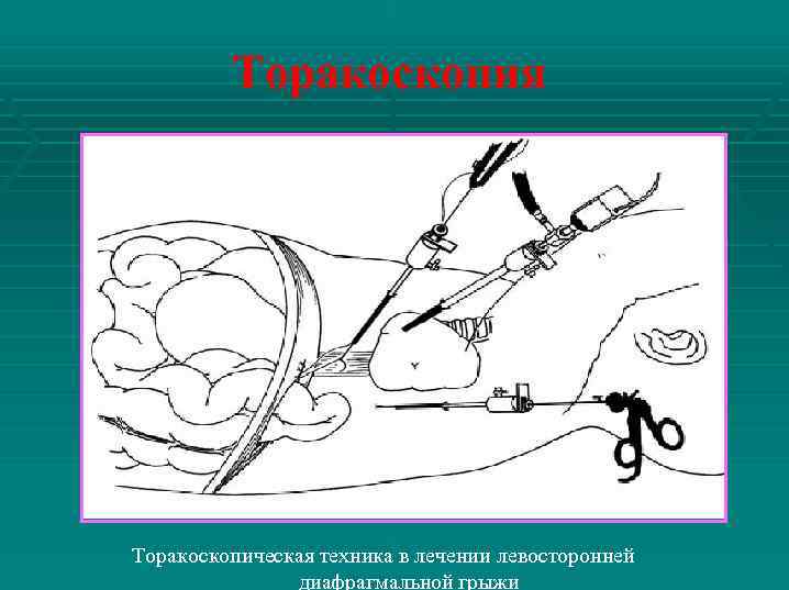 Торакоскопия Торакоскопическая техника в лечении левосторонней диафрагмальной грыжи 