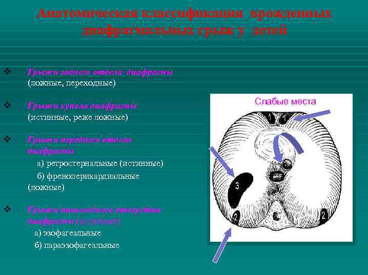 Анатомическая классификация врожденных диафрагмальных грыж у детей v Грыжи заднего отдела диафрагмы (ложные, переходные)