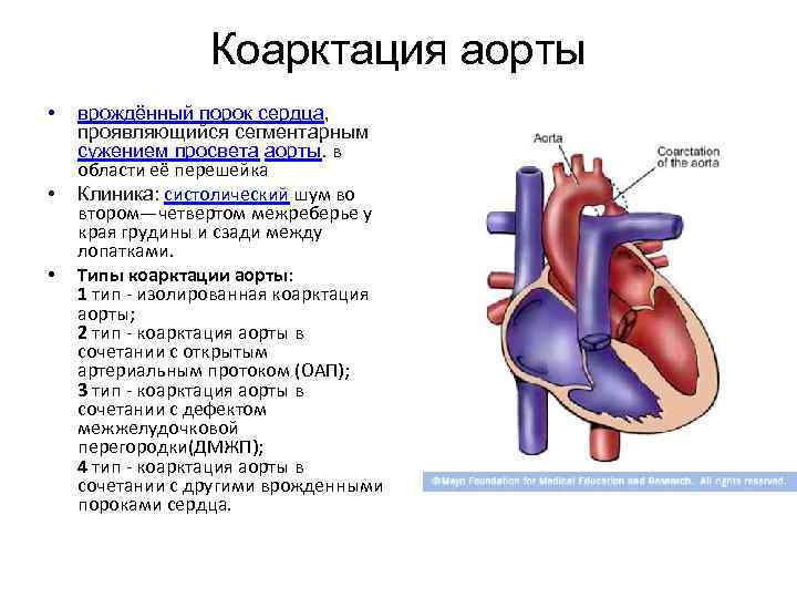 Аорта врожденная