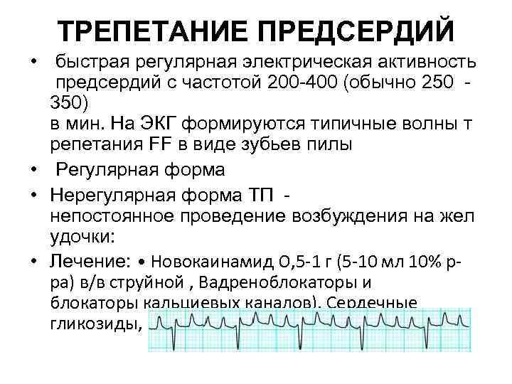 Трепетание предсердий