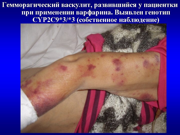Гемморагический васкулит, развившийся у пациентки применении варфарина. Выявлен генотип CYP 2 C 9*3/*3 (собственное