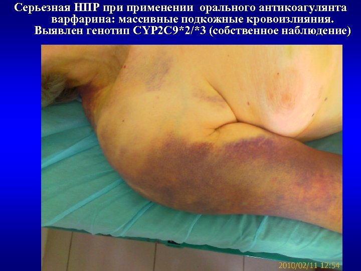 Серьезная НПР применении орального антикоагулянта варфарина: массивные подкожные кровоизлияния. Выявлен генотип CYP 2 C