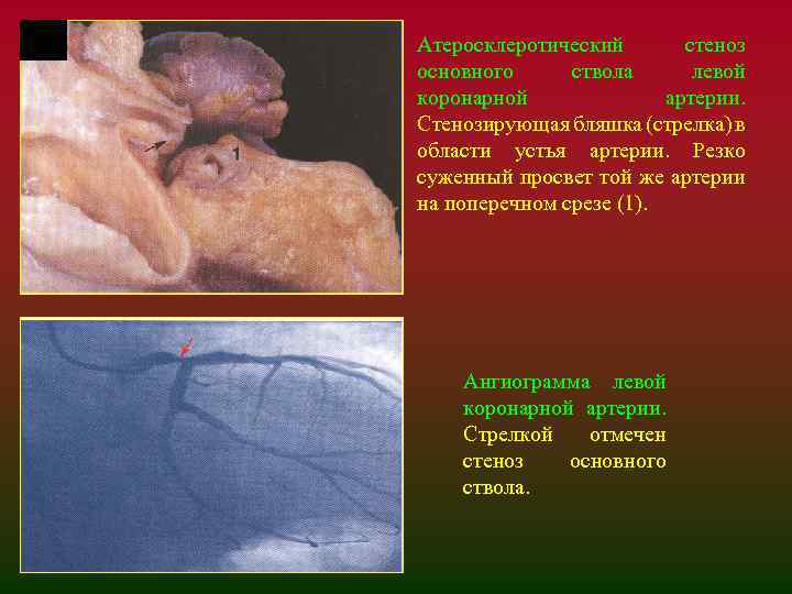 Атеросклеротический стеноз основного ствола левой коронарной артерии. Стенозирующая бляшка (стрелка) в области устья артерии.