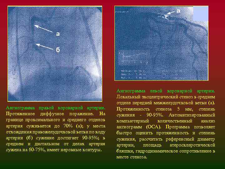 Ангиограмма правой коронарной артерии. Протяженное диффузное поражение. На границе проксимального и среднего отделов артерия