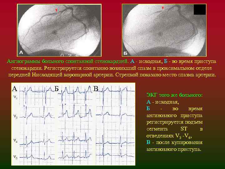 Ангиограммы больного спонтанной стенокардией. А - исходная, Б - во время приступа стенокардии. Регистрируется