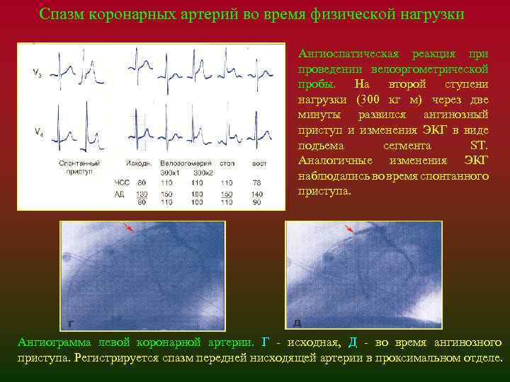 Спазм коронарных артерий во время физической нагрузки Ангиоспатическая реакция при проведении велоэргометрической пробы. На