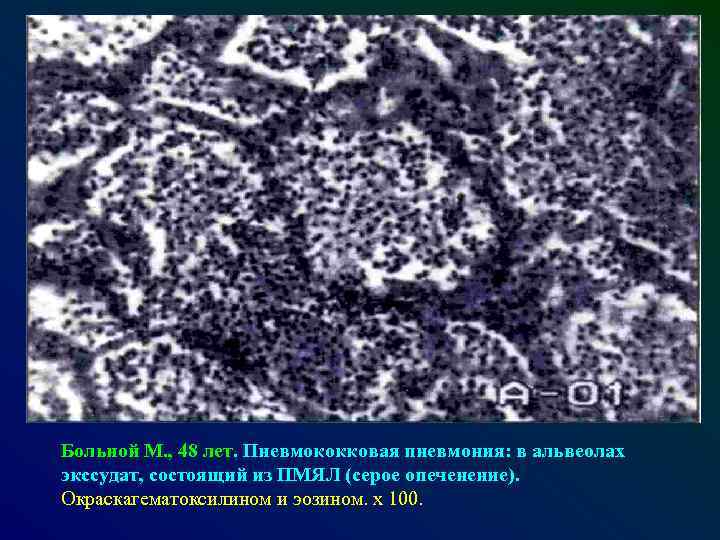 Больной М. , 48 лет. Пневмококковая пневмония: в альвеолах экссудат, состоящий из ПМЯЛ (серое
