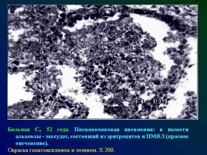 Больная С. , 52 года. Пневмококковая пневмония: в полости альвеолы - экссудат, состоящий из