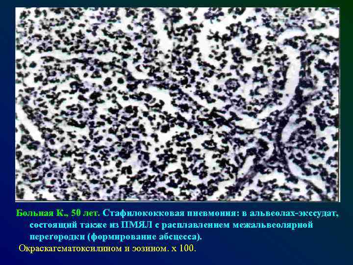 Больная К. , 50 лет. Стафилококковая пневмония: в альвеолах-экссудат, состоящий также из ПМЯЛ с