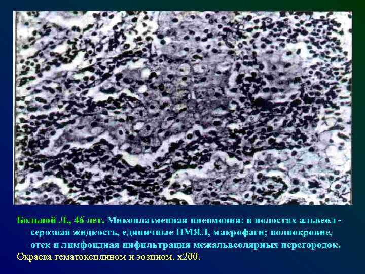 Больной Л. , 46 лет. Микоплазменная пневмония: в полостях альвеол серозная жидкость, единичные ПМЯЛ,