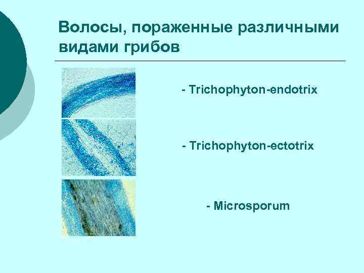 Волосы, пораженные различными видами грибов - Trichophyton-endotrix - Trichophyton-ectotrix - Microsporum 