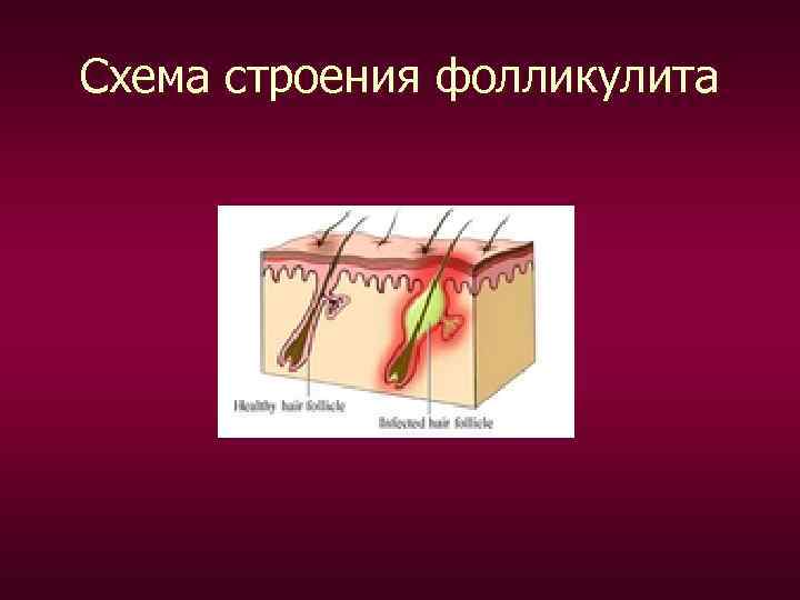 Схема строения фолликулита 