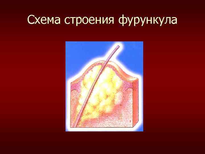 Схема строения фурункула 