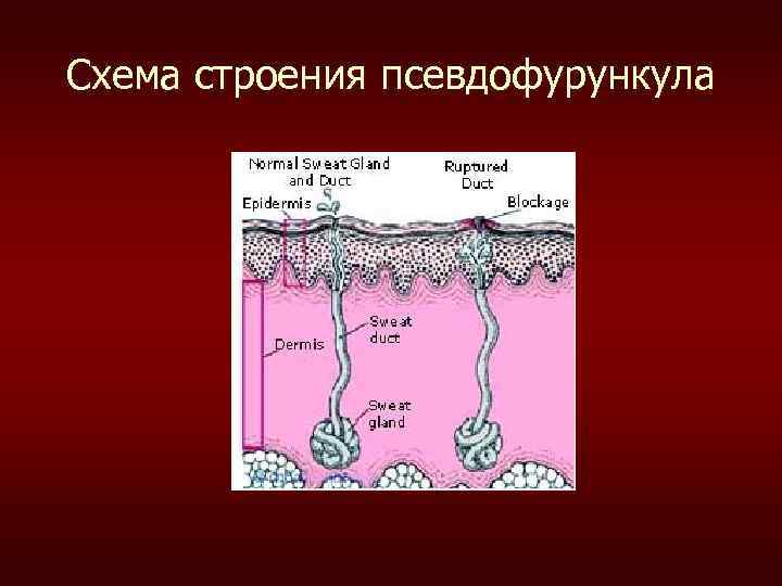 Псевдофурункулеза клиническая картина