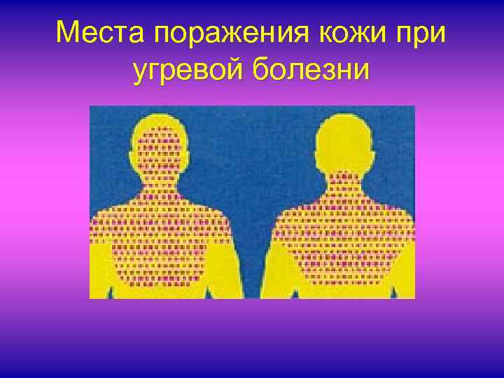 Места поражения кожи при угревой болезни 