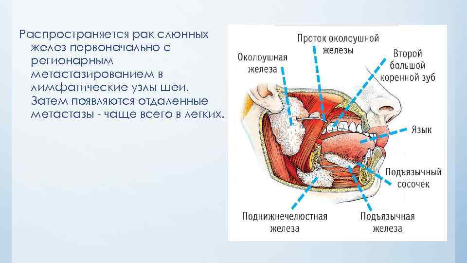 Распространяется рак слюнных желез первоначально с регионарным метастазированием в лимфатические узлы шеи. Затем появляются