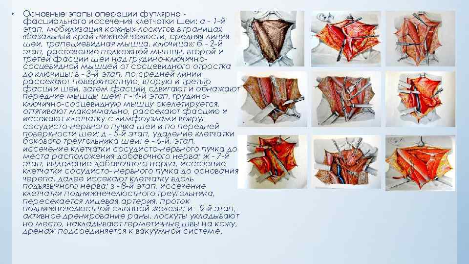  • Основные этапы операции футлярно фасциального иссечения клетчатки шеи: а - 1 -й
