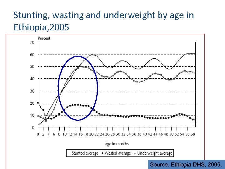 Stunting, wasting and underweight by age in Ethiopia, 2005 Source: Ethiopia DHS, 2005. 