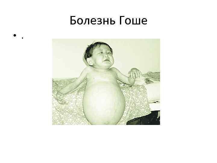 Болезнь Гоше • . 