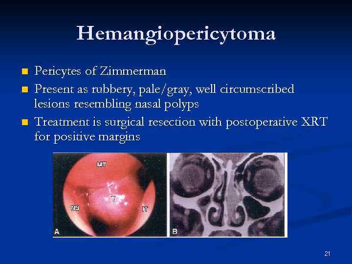 Hemangiopericytoma n n n Pericytes of Zimmerman Present as rubbery, pale/gray, well circumscribed lesions