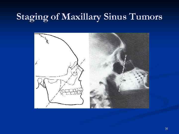 Staging of Maxillary Sinus Tumors 31 