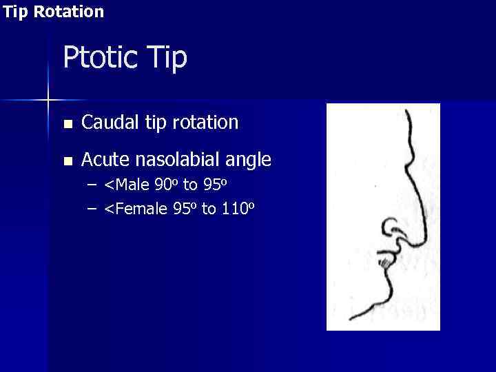 Tip Rotation Ptotic Tip n Caudal tip rotation n Acute nasolabial angle – <Male