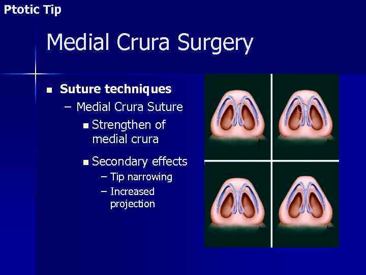 Ptotic Tip Medial Crura Surgery n Suture techniques – Medial Crura Suture n Strengthen