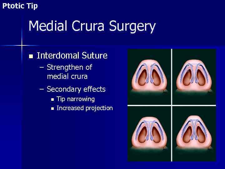 Ptotic Tip Medial Crura Surgery n Interdomal Suture – Strengthen of medial crura –