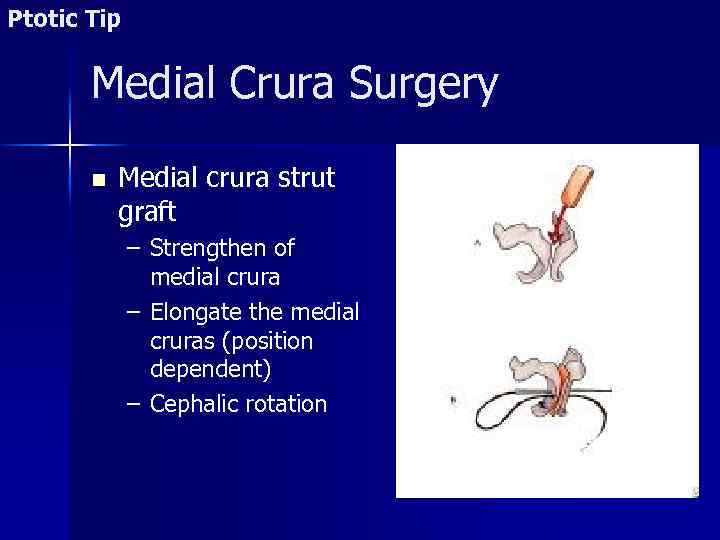 Ptotic Tip Medial Crura Surgery n Medial crura strut graft – Strengthen of medial