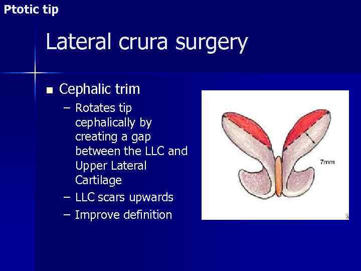 Ptotic tip Lateral crura surgery n Cephalic trim – Rotates tip cephalically by creating