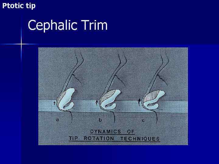 Ptotic tip Cephalic Trim 