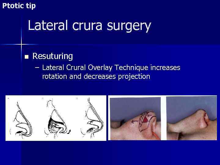 Ptotic tip Lateral crura surgery n Resuturing – Lateral Crural Overlay Technique increases rotation