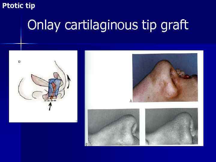 Ptotic tip Onlay cartilaginous tip graft 