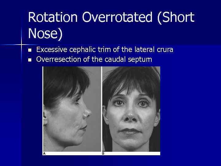 Rotation Overrotated (Short Nose) n n Excessive cephalic trim of the lateral crura Overresection