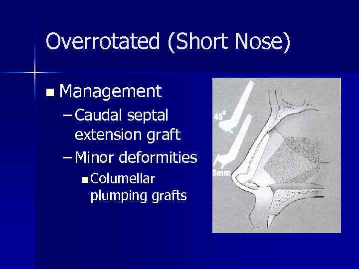 Overrotated (Short Nose) n Management – Caudal septal extension graft – Minor deformities n