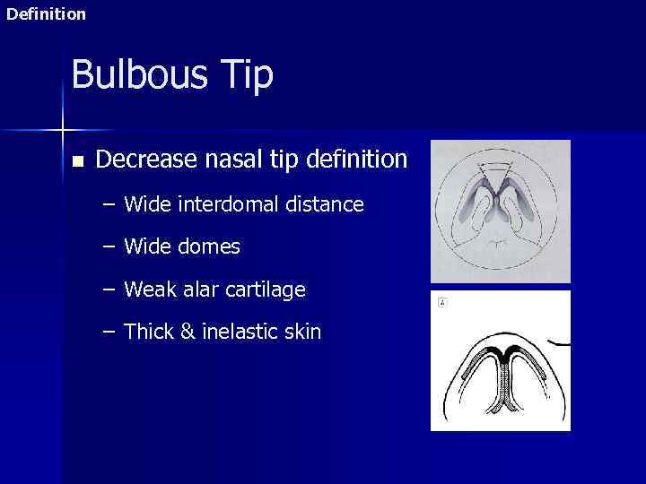 Definition Bulbous Tip n Decrease nasal tip definition – Wide interdomal distance – Wide
